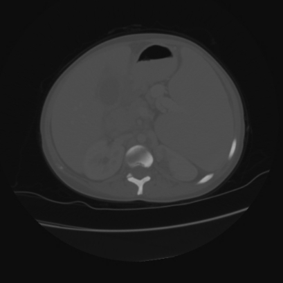 File:Acute calculous cholecystitis in patient with osteopetrosis (Radiopaedia 77871-90159 Axial bone window 19).jpg