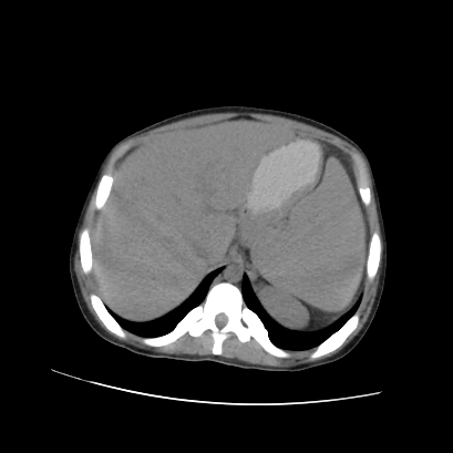 File:Acute calculous cholecystitis in patient with osteopetrosis (Radiopaedia 77871-90159 Axial non-contrast 22).jpg