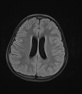 File:Acute cerebellar ataxia (Radiopaedia 61487-69446 Axial FLAIR 14).jpg