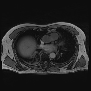 Acute cholecystitis (Radiopaedia 72392-82923 Axial T1 out-of-phase 8).jpg