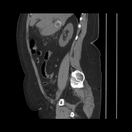 Acute cholecystitis with tensile fundus sign (Radiopaedia 71394-81723 Sagittal non-contrast 69).jpg