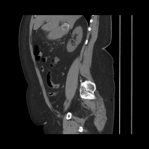 Acute cholecystitis with tensile fundus sign (Radiopaedia 71394-81723 Sagittal non-contrast 70).jpg