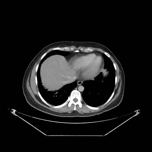 File:Acute complicated calculous cholecystitis (Radiopaedia 55202-61587 Axial C+ delayed 19).jpg