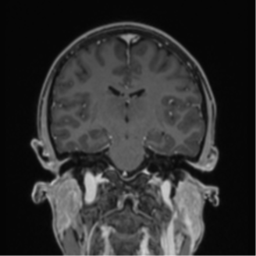 Acute disseminated encephalomyelitis (ADEM) (Radiopaedia 65319-74349 Coronal T1 C+ 22).png