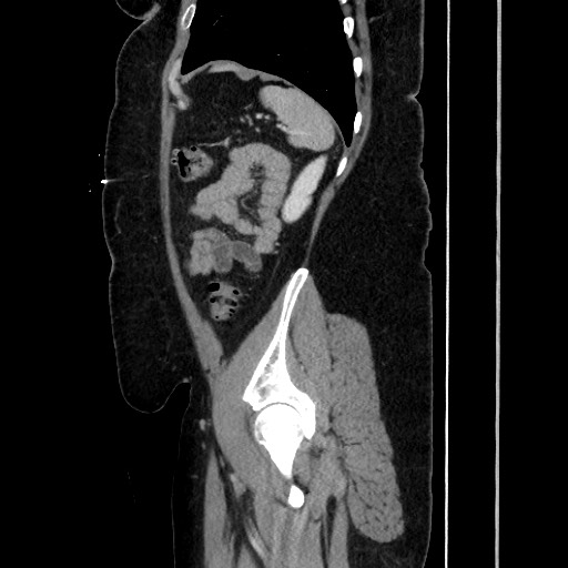 Acute diverticulitis - transverse colon (Radiopaedia 87063-103327 Sagittal C+ portal venous phase 171).jpg