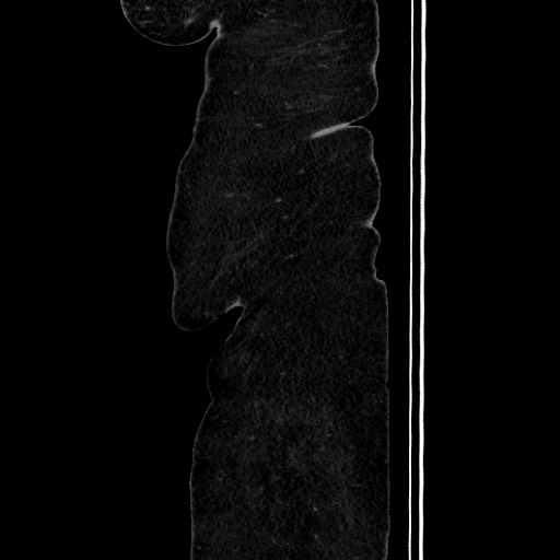 Acute diverticulitis - transverse colon (Radiopaedia 87063-103327 Sagittal C+ portal venous phase 33).jpg