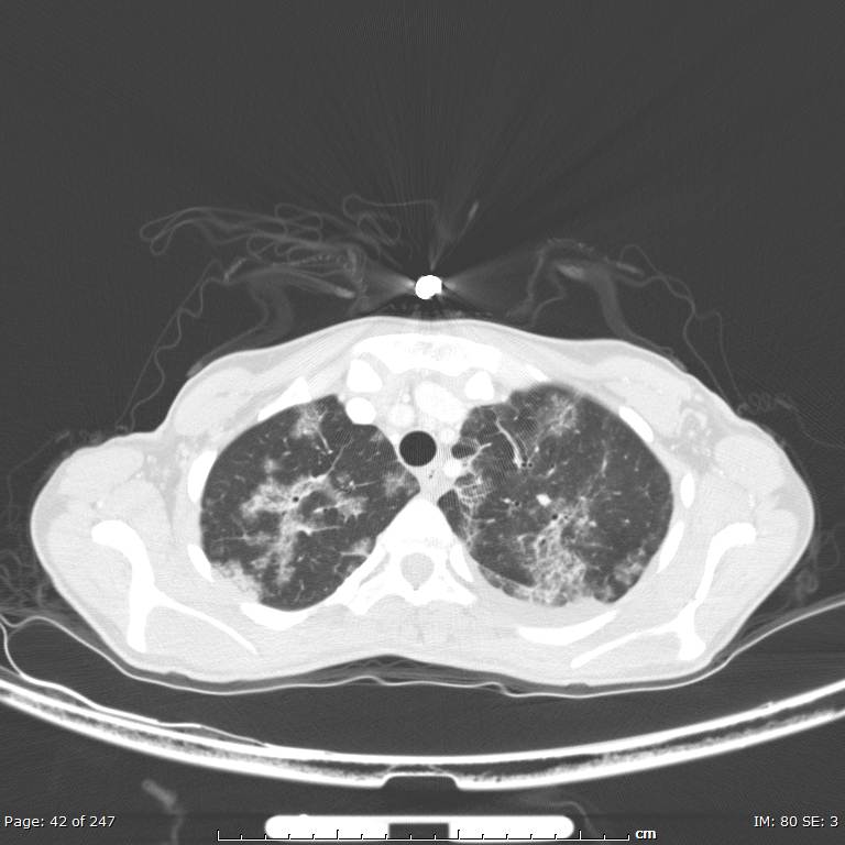 Acute eosinophilic pneumonia (Radiopaedia 48211-53073 Axial lung window 15).jpg