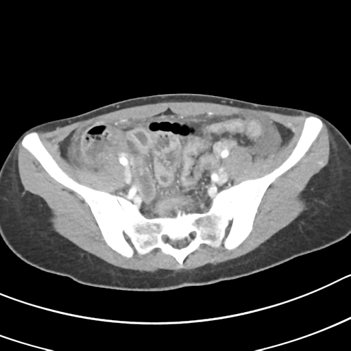 Acute gangrenous appendicitis with perforation (Radiopaedia 40152-42662 Axial C+ portal venous phase 56).png