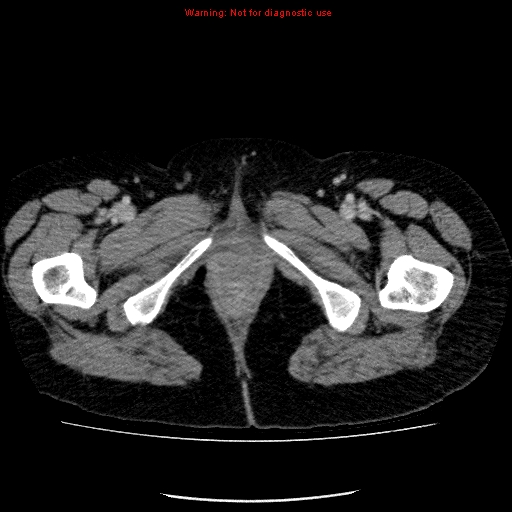Acute gangrenous cholecystitis (Radiopaedia 10123-10661 Axial C+ portal venous phase 108).jpg