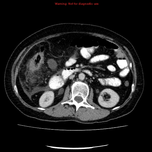 Acute gangrenous cholecystitis (Radiopaedia 10123-10661 Axial C+ portal venous phase 45).jpg