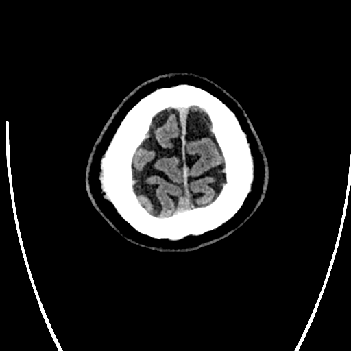 Acute left middle cerebral artery territory ischemic stroke (Radiopaedia 35688-37223 Axial non-contrast 82).png