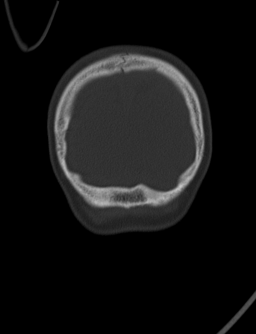Acute mastoiditis (Radiopaedia 82678-96881 Coronal bone window 75).jpg