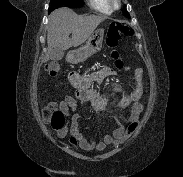 Acute mesenteric ischemia (Radiopaedia 80029-93316 Coronal C+ arterial phase 31).jpg