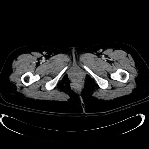 File:Acute myocardial infarction in CT (Radiopaedia 39947-42415 Axial C+ portal venous phase 148).jpg