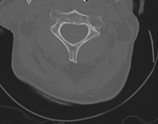 Acute on chronic subdural hematoma and thoracic vertebral injury in a multitrauma patient (Radiopaedia 31698-32619 Axial bone window 19).jpg