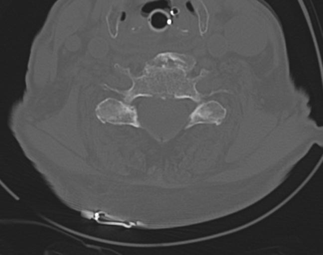 Acute on chronic subdural hematoma and thoracic vertebral injury in a multitrauma patient (Radiopaedia 31698-32619 Axial bone window 40).jpg