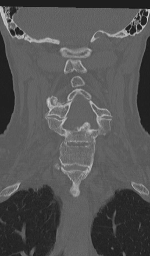 Acute on chronic subdural hematoma and thoracic vertebral injury in a multitrauma patient (Radiopaedia 31698-32619 Coronal bone window 32).jpg