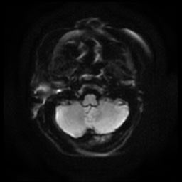 Acute otitis externa (Radiopaedia 57296-64236 Axial DWI 7).jpg