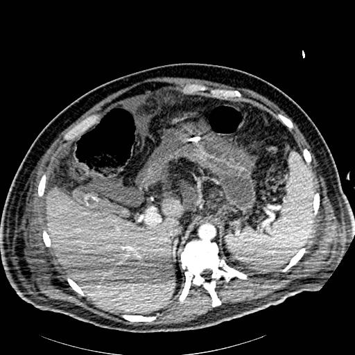 File:Acute pancreatic necrosis (Radiopaedia 13560-18502 Axial C+ portal venous phase 10).jpg