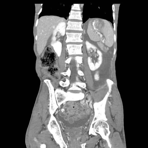 File:Acute pancreatitis (Radiopaedia 50213-55558 Coronal C+ portal venous phase 31).jpg