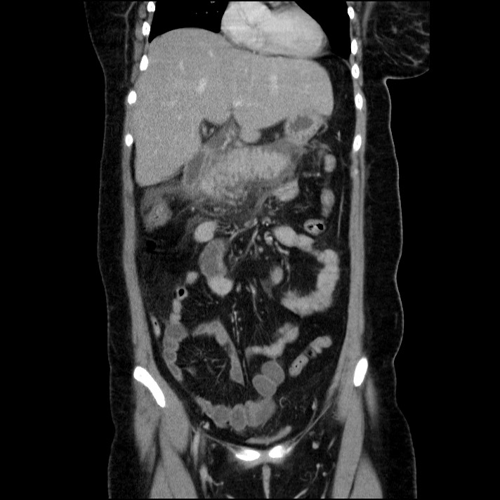 Acute pancreatitis (Radiopaedia 69236-79012 Coronal C+ portal venous phase 48).jpg