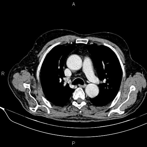 File:Acute pancreatitis (Radiopaedia 85146-100701 Axial C+ portal venous phase 1).jpg