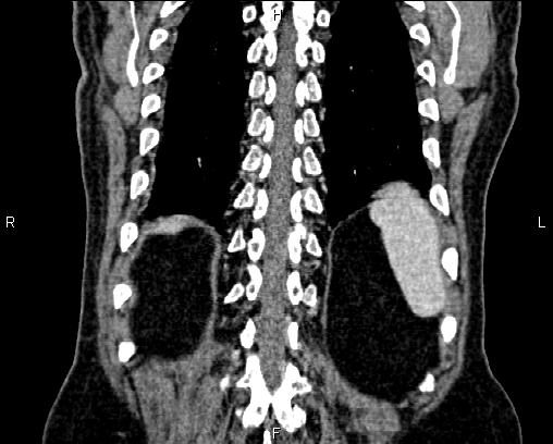 Acute pancreatitis (Radiopaedia 85146-100701 Coronal C+ portal venous phase 65).jpg