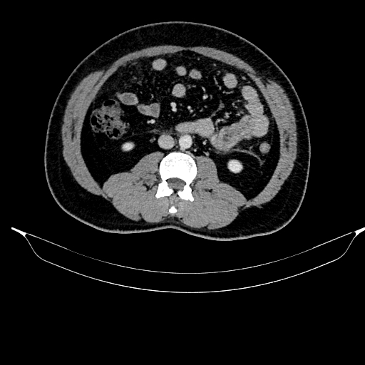 Acute pancreatitis (Radiopaedia 87428-103757 Axial C+ portal venous phase 53).jpg