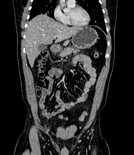 File:Acute pancreatitis (Radiopaedia 87428-103757 Coronal C+ portal venous phase 32).jpg