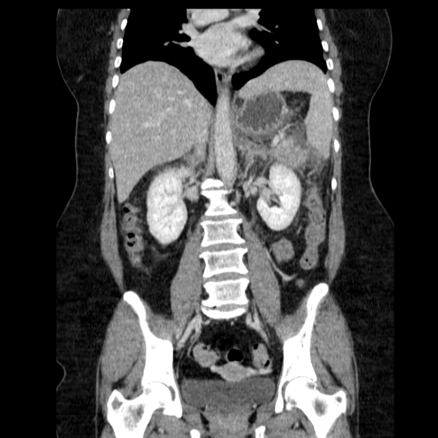 Acute pancreatitis - Balthazar C (Radiopaedia 26569-26714 Coronal C+ portal venous phase 40).jpg