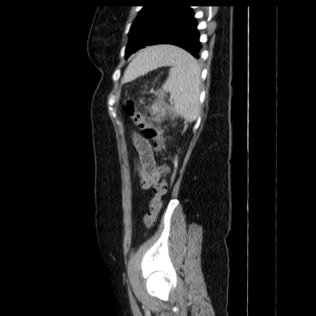 Acute pancreatitis - Balthazar C (Radiopaedia 26569-26714 Sagittal C+ portal venous phase 55).jpg