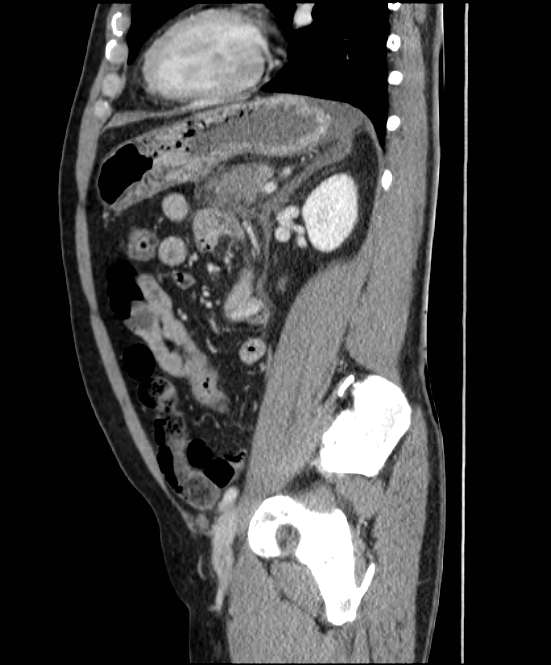 Acute pancreatitis - Balthazar E (Radiopaedia 23080-23110 Sagittal C+ portal venous phase 67).jpg