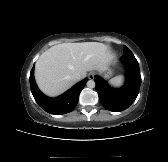 Acute pancreatitis - Balthazar E - post ERCP (Radiopaedia 27562-27772 Axial C+ portal venous phase 12).png
