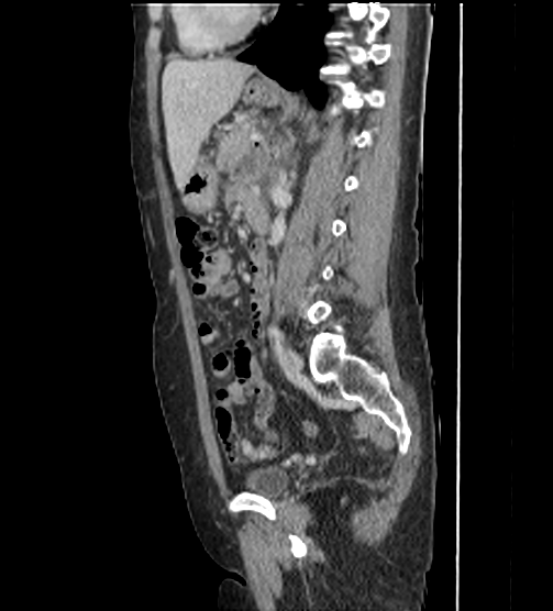 Acute pancreatitis - Balthazar E - post ERCP (Radiopaedia 27562-27772 Sagittal C+ portal venous phase 81).png