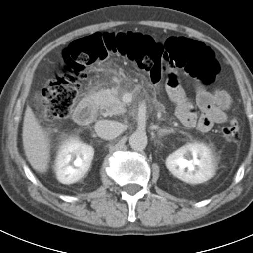 Acute pancreatitis and walled-off necrosis (Radiopaedia 29888-30403 Axial C+ delayed 32).jpg