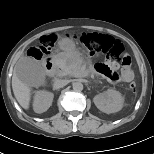 File:Acute pancreatitis and walled-off necrosis (Radiopaedia 29888-30404 Axial non-contrast 29).jpg