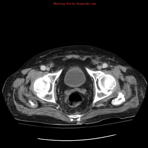 File:Acute pancreatitis with incidental pancreatic lipoma (Radiopaedia 10190-10730 Axial C+ portal venous phase 73).jpg