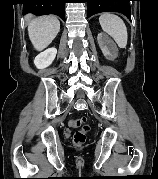 Acute renal infarction (Radiopaedia 59375-66736 Coronal C+ portal venous phase 47).jpg