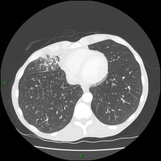 Acute right lung abscess (Radiopaedia 34806-36258 Axial lung window 139).jpg