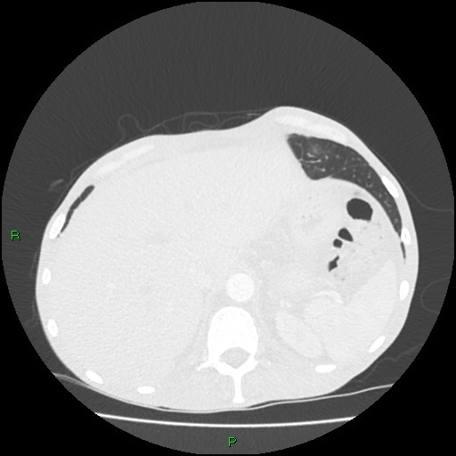 Acute right lung abscess (Radiopaedia 34806-36258 Axial lung window 175).jpg