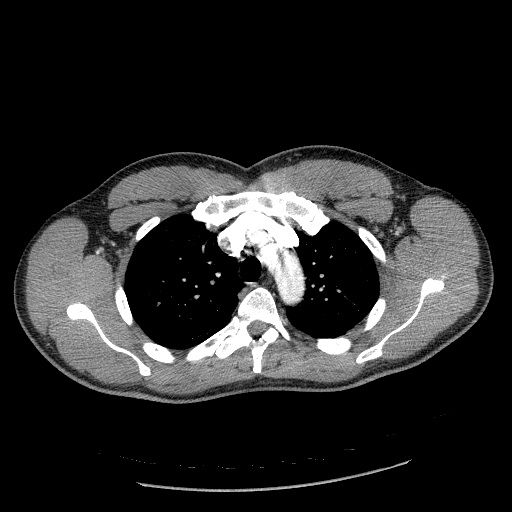 File:Acute segmental pulmonary emboli and pulmonary infarction (Radiopaedia 62264-70444 Axial C+ CTPA 34).jpg