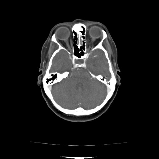 File:Acute subarachnoid hemorrhage and accessory anterior cerebral artery (Radiopaedia 69231-79009 Axial C+ arterial phase 87).jpg