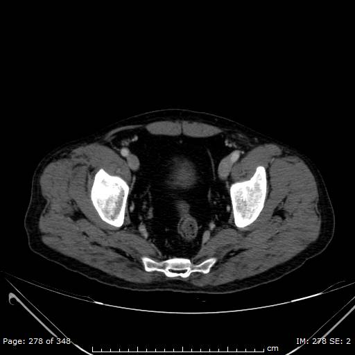 Acute superior mesenteric artery occlusion (Radiopaedia 43636-47060 Axial C+ portal venous phase 56).jpg