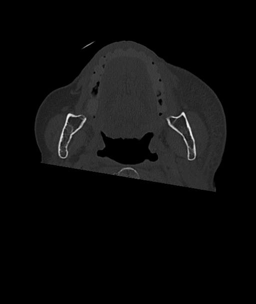 Acute traumatic subdural hematoma (Radiopaedia 82921-97257 Axial bone window 118).jpg