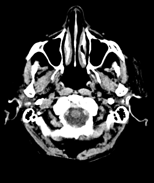 Acute traumatic subdural hematoma (Radiopaedia 82921-97257 Axial non-contrast 59).jpg