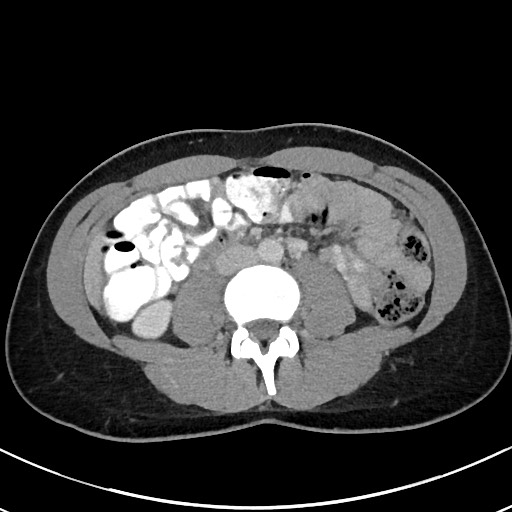 Acute uncomplicated appendicitis (Radiopaedia 61374-69304 Axial C+ portal venous phase 61).jpg