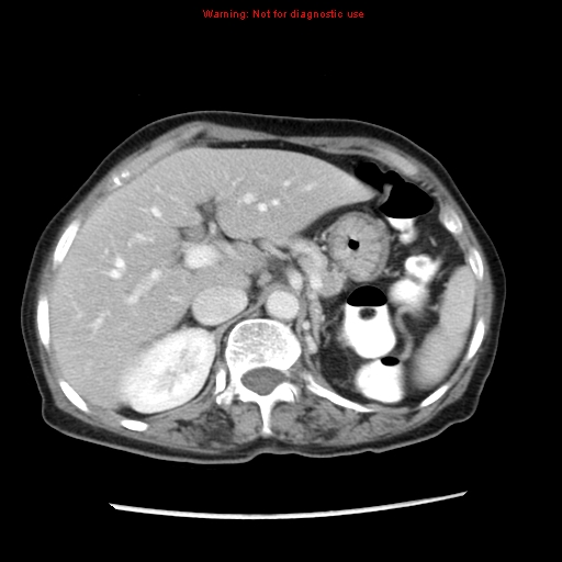 Adenocarcinoma of the colon (Radiopaedia 8191-9039 Axial liver window 21).jpg
