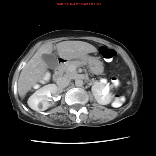 Adenocarcinoma of the colon (Radiopaedia 8191-9039 Axial renal excretory phase 14).jpg
