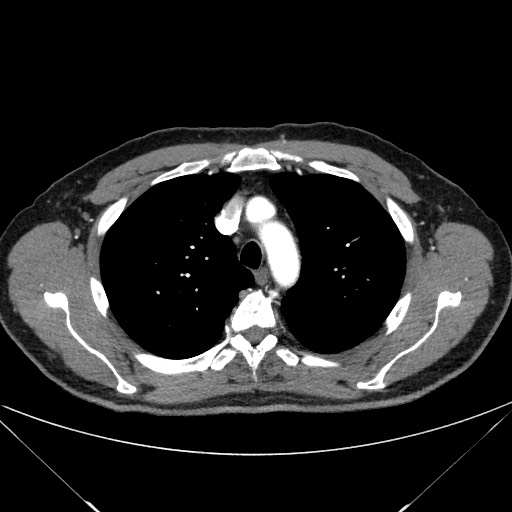 File:Adenocarcinoma of the lung (Radiopaedia 59871-67325 Axial C+ arterial phase 24).jpg