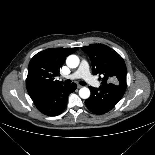 File:Adenocarcinoma of the lung (Radiopaedia 59871-67325 Axial C+ arterial phase 39).jpg